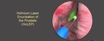 Quy trình phẫu thuật nội soi bóc nhân tuyến tiền liệt bằng Laser Holmium